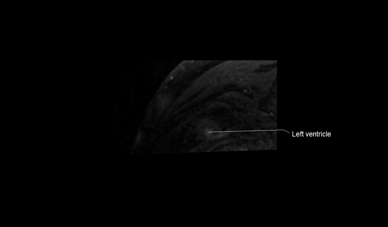 MRI heart and coronary arteries short axis anatomy image 41.webp